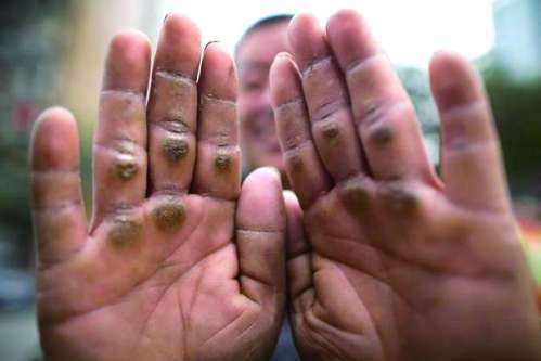 滿手的繭子 滿手的繭子